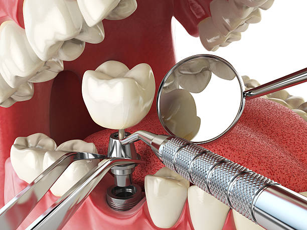 Best Emergency Dentist for Knocked-Out Tooth in Bedford, IA